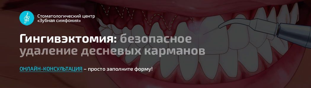 Гингивэктомия в Минске, цены, отзывы пациентов, примеры работ