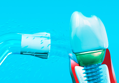 Как ухаживать за зубами после установки импланта