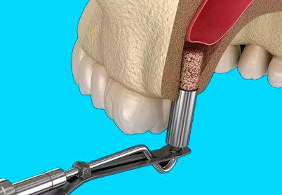 Синус-лифтинг: как проходит операция?