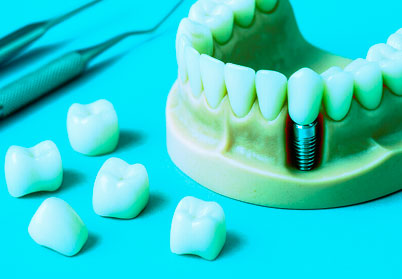 Рассказываем о возможностях протезирования