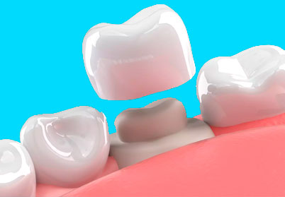 Как проходит установка коронки на зуб 