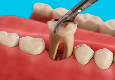 Удаление нескольких зубов за один визит: безопасно ли?