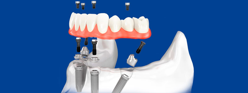 Имплантация в один этап стала реальностью!