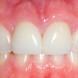 6 reasons why having metal-free zirconia dental implants