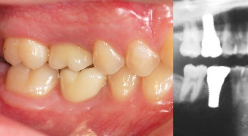 6 reasons why having metal-free zirconia dental implants