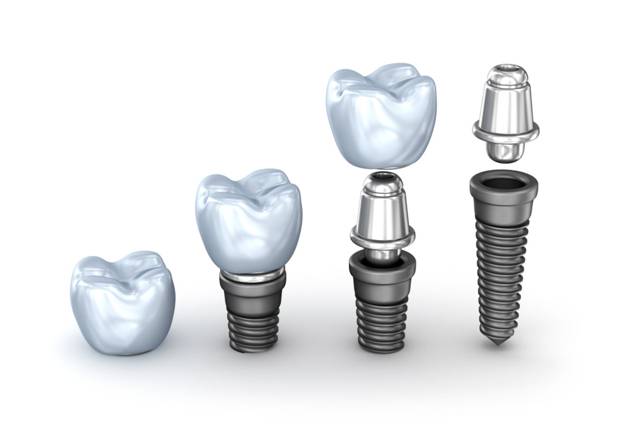 Зубные импланты: какие выбрать и цены