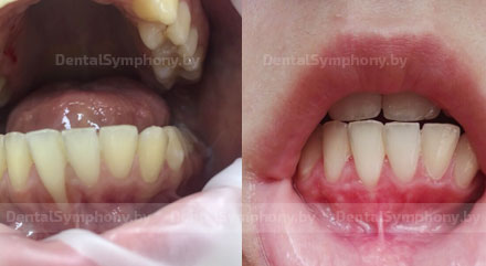 Устранение рецессии зуба во фронтальном отделе нижней челюсти