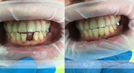 Шинирование зубов и восстановление анатомической формы зуба