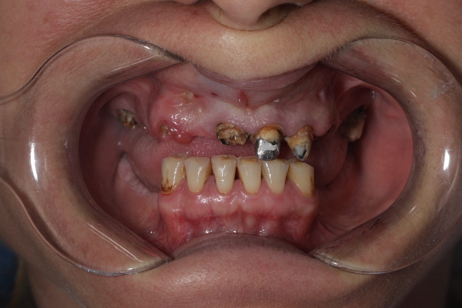 Тотальное протезирование верхней и нижней челюсти