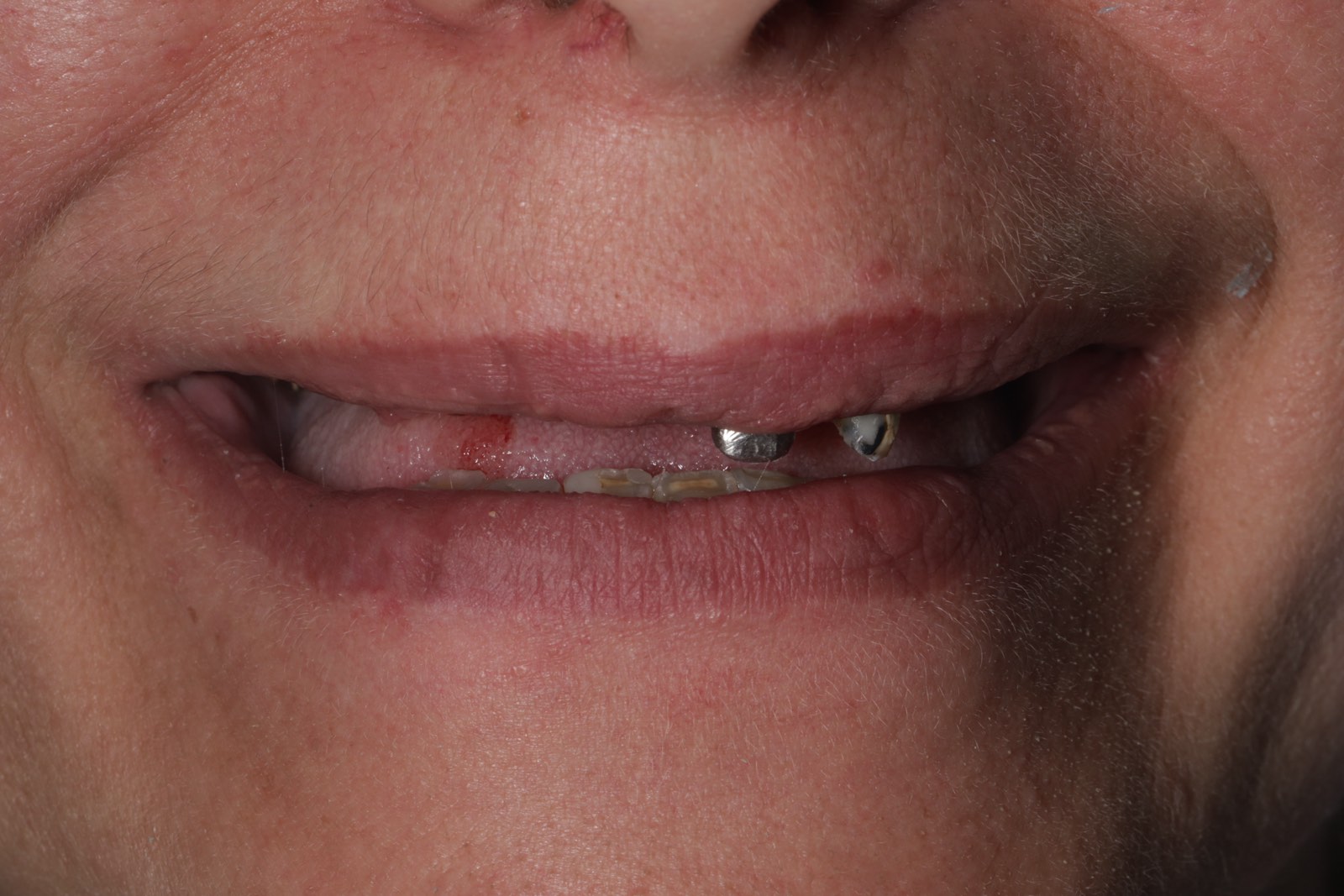 Тотальное протезирование верхней и нижней челюсти