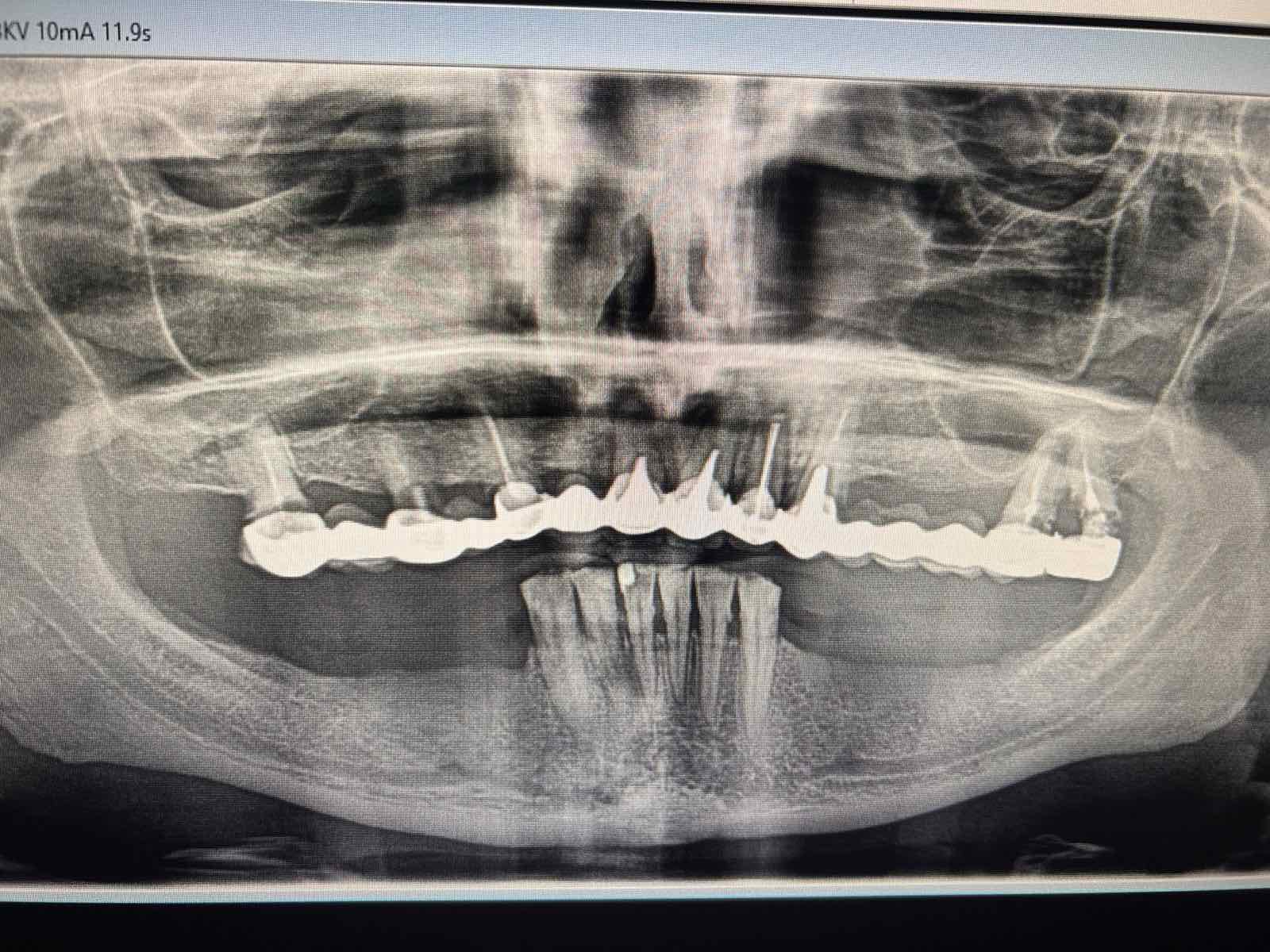 Тотальное протезирование верхней и нижней челюсти