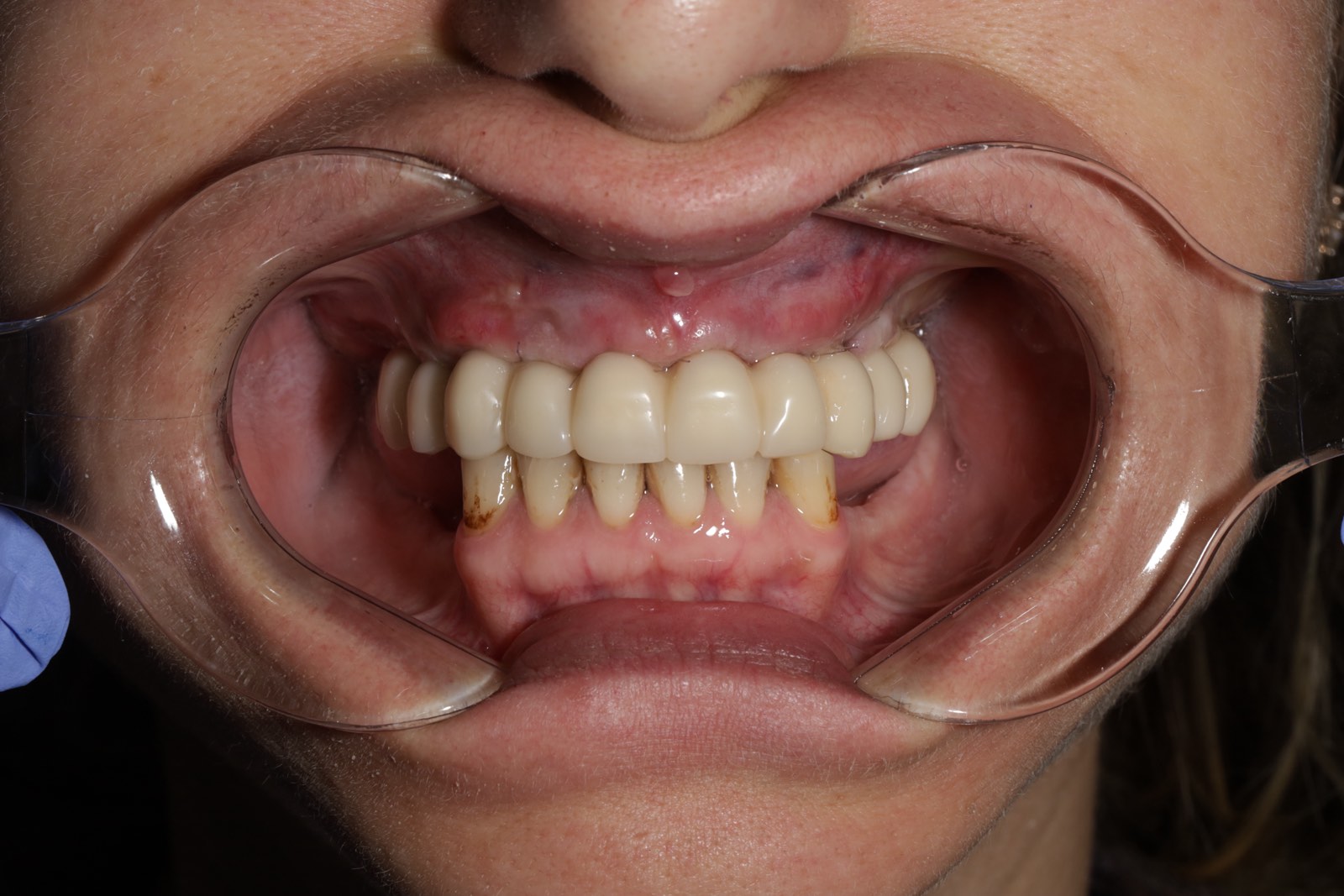 Тотальное протезирование верхней и нижней челюсти