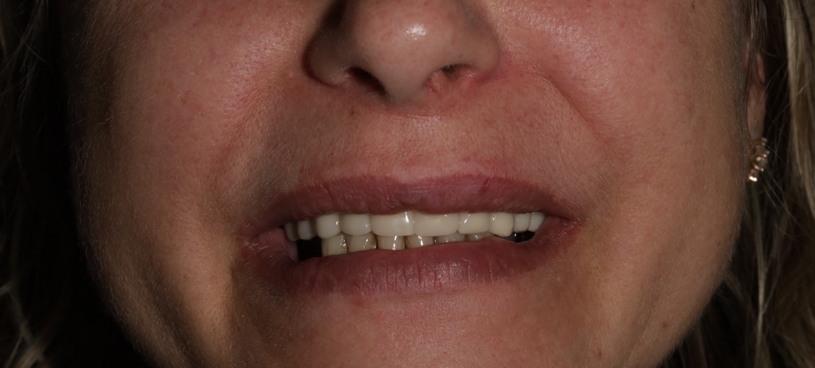 Тотальное протезирование верхней и нижней челюсти