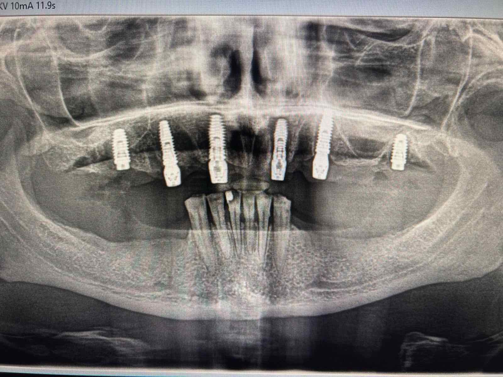 Тотальное протезирование верхней и нижней челюсти