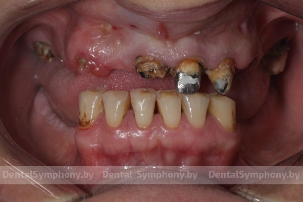 Полное восстановление зубов верхней челюсти по технологиям All-on-4 и All-on-6